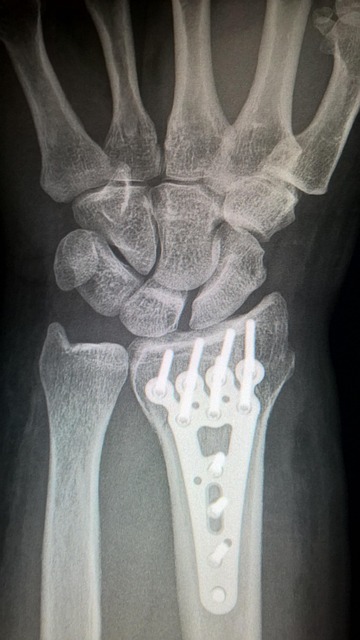 broken arm, plate fixation, titanium plate, fracture of radius, wrist, surgery, trauma surgery, x-ray image, bone, broken arm, broken arm, broken arm, broken arm, broken arm, surgery, surgery, bone